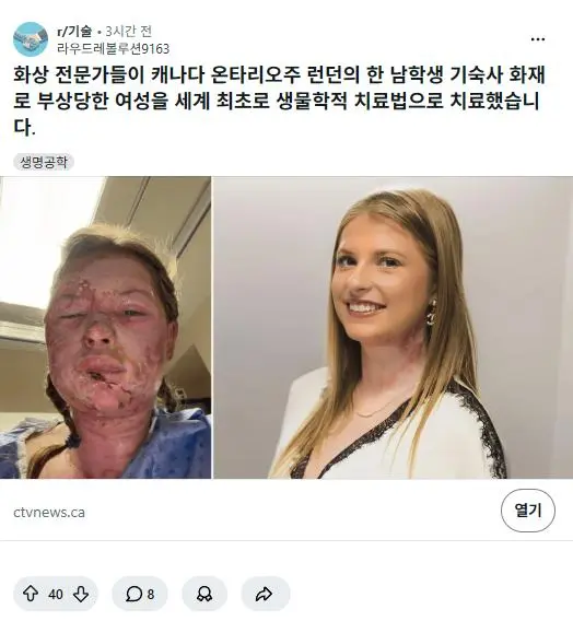 엄청나게 발전한 화상치료 최신 기술